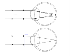 Tratament Astigmatism - Vindecarea Naturatala a Astigmatismului - Astigmatism Miopic
